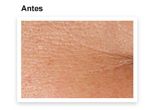 Ver la apariencia de la piel antes de aplicar las Láminas Activadoras de Vitamina C TimeWise Activating Squares