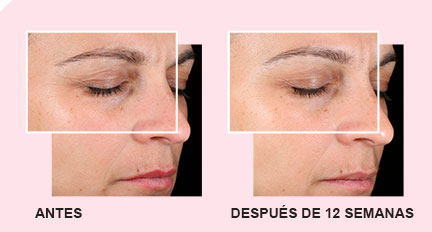 Descubre los efectos que tiene el Set Milagroso 3D TimeWise sobre tu rostro con estas imágenes de antes y después de 12 semanas de usar el Set sobre el rostro