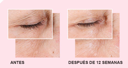 Descubre las imágenes de antes y después de 12 semanas de usar el Set Milagroso 3D sobre la zona del contorno de los ojos
