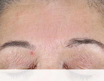 Mary Kay Clinical Solutions Retinol 0.5 Set after image of forehead